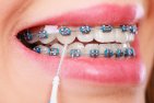 155067-4-dicas-de-higiene-para-quem-utiliza-aparelho-ortodontico-fixo