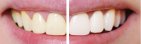 clareamento-dental