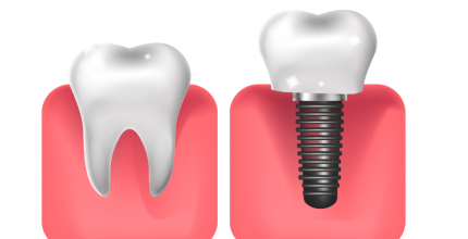 Implantes Dentários: Afinal: quando é indicado fazer esse procedimento? 
