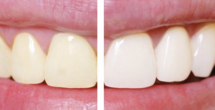 Como é realizado o clareamento nos dentes?